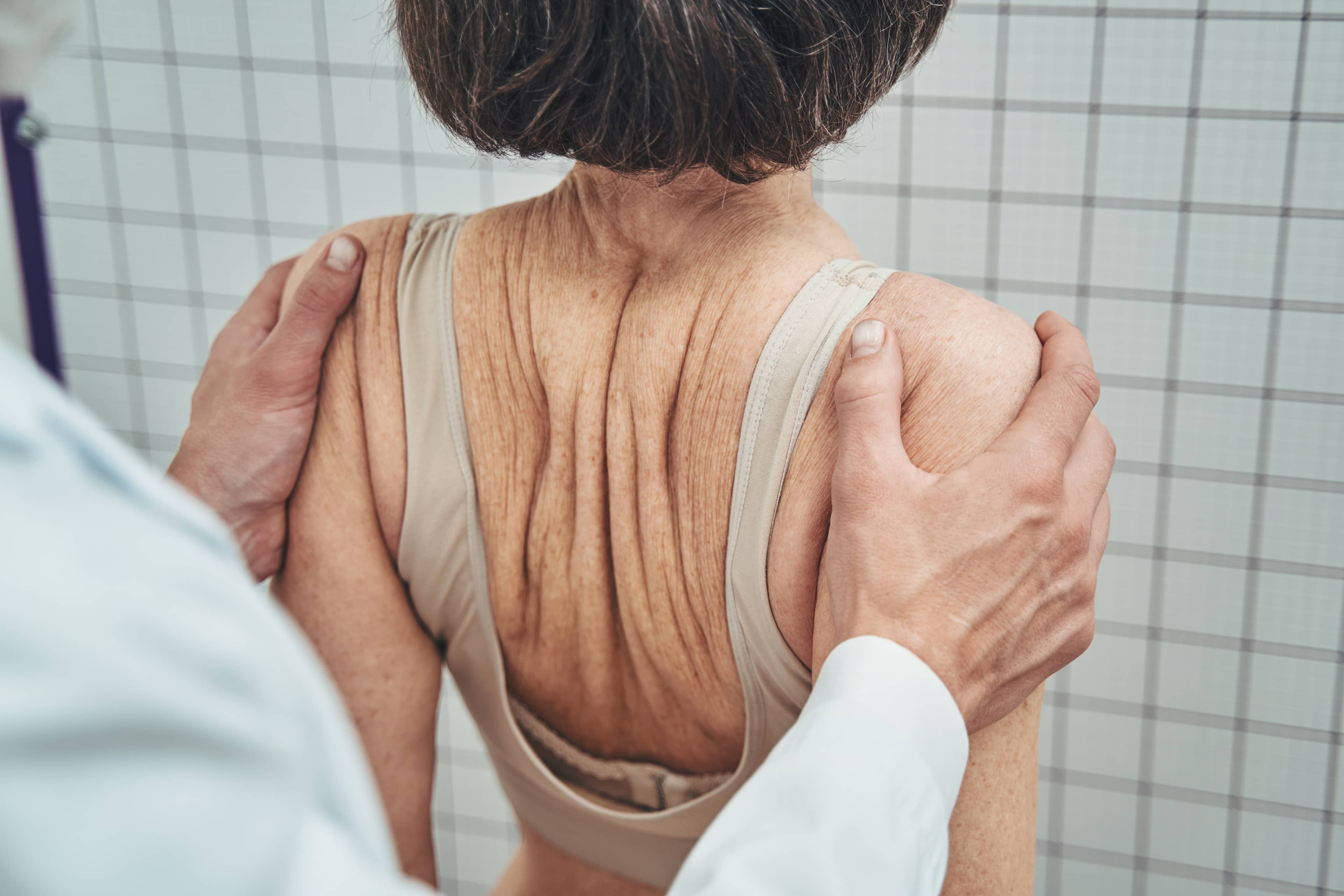 escoliosis